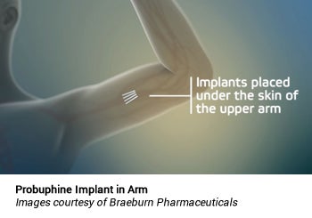 Probuphine Implant in Arm: Images courtesy of Braeburn Pharmaceuticals
